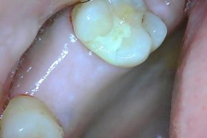 Mai implant 1