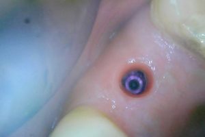 Mai implant 2