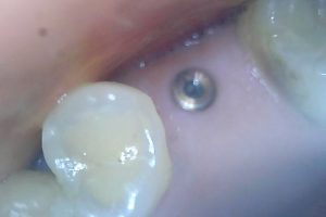 Mai implant 3