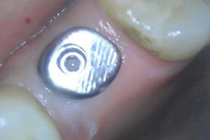 Mai implant 4