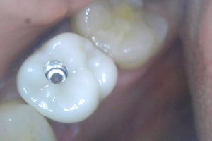 Mai implant 5