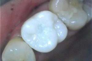 Mai implant 6